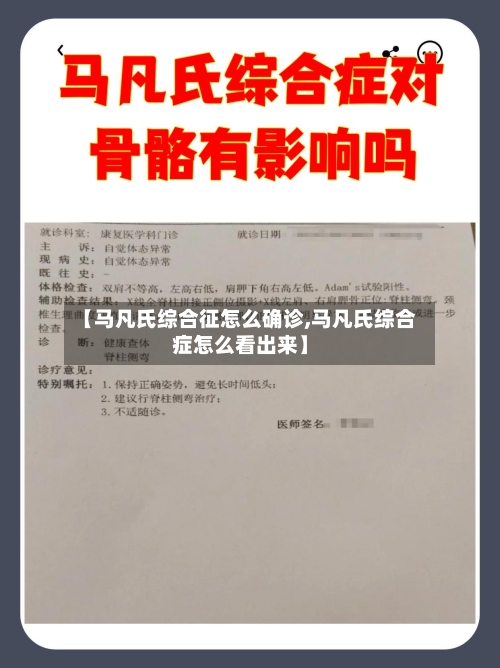 【马凡氏综合征怎么确诊,马凡氏综合症怎么看出来】
