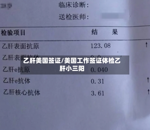 乙肝美国签证/美国工作签证体检乙肝小三阳-第2张图片
