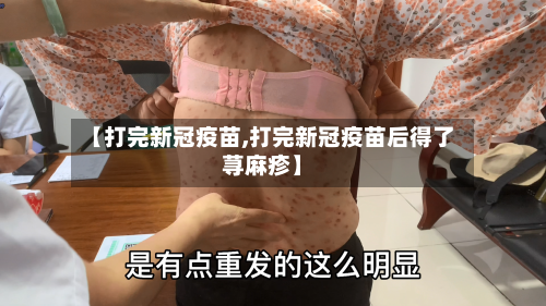 【打完新冠疫苗,打完新冠疫苗后得了荨麻疹】