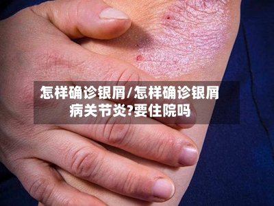 怎样确诊银屑/怎样确诊银屑病关节炎?要住院吗